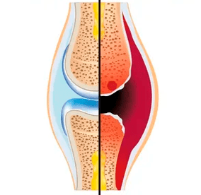 La struttura di un'articolazione sana e usurata con la designazione di tessuto cartilagineo e liquido sinoviale