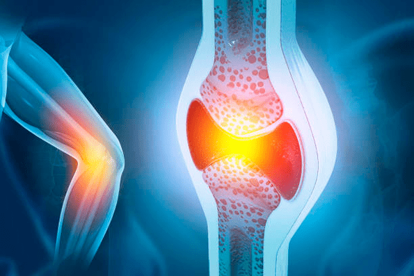 Prevenzione delle malattie articolari