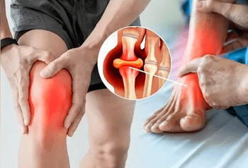 Schema per l'applicazione del gel Icexin sull'area dell'articolazione del ginocchio e del piede